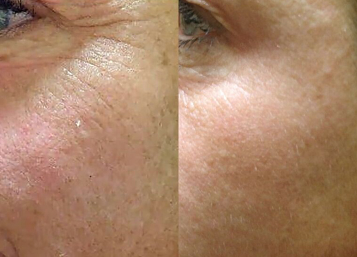 SkinPen before and after